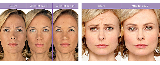 Botox® Cosmetic Facial Results